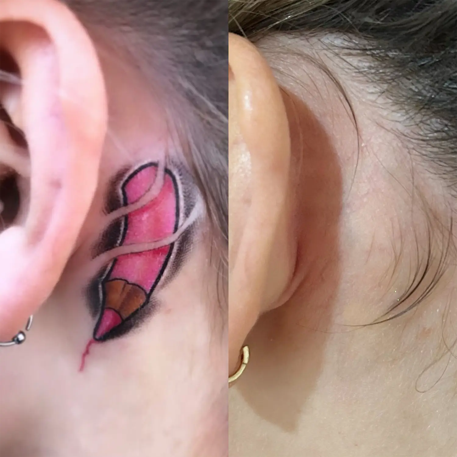 Despigmentación láser de tatuajes en Madrid