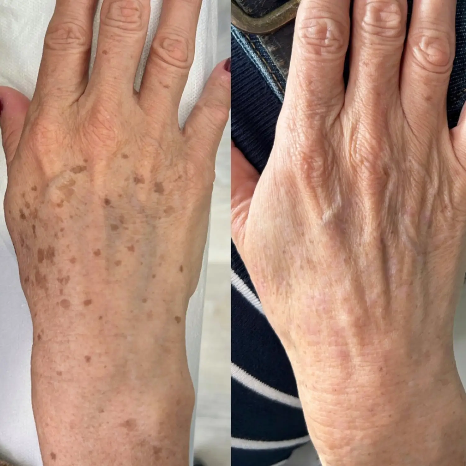 Despigmentación láser en Madrid