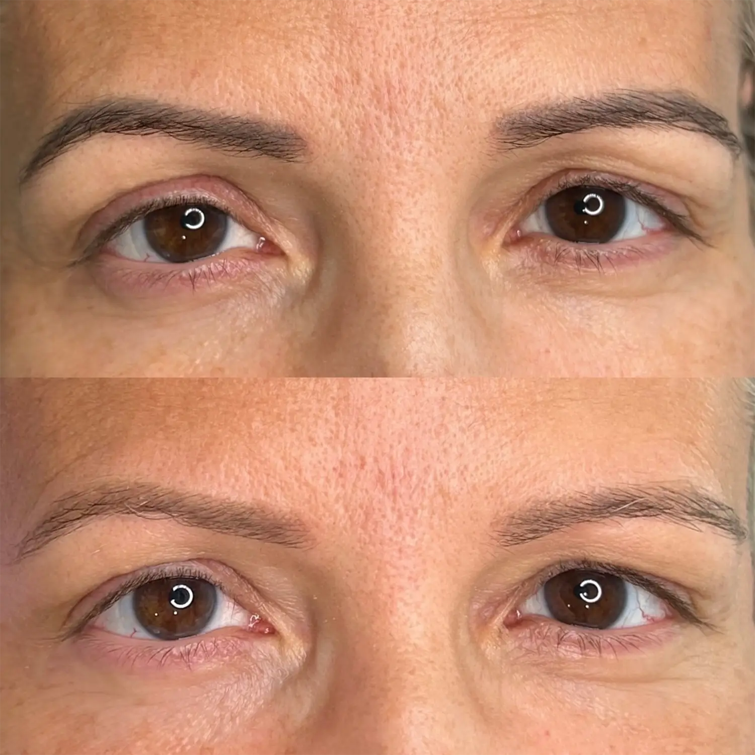 Despigmentación láser para cejas en Madrid